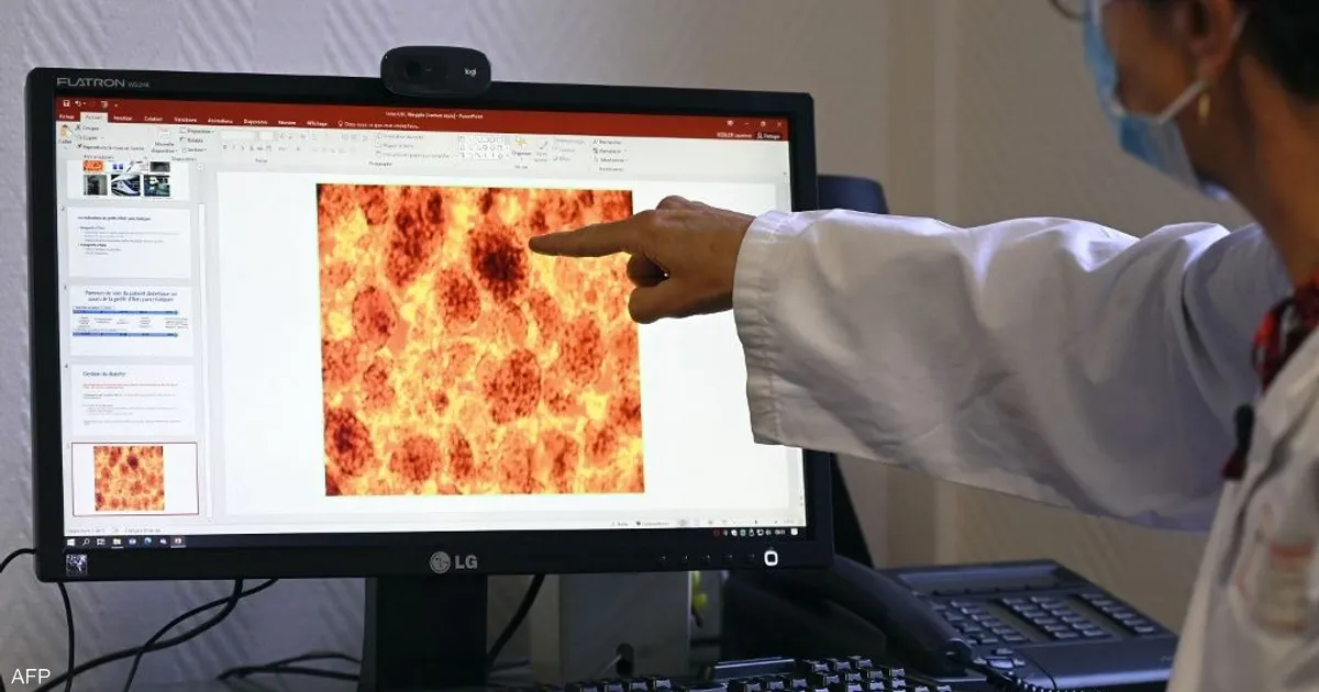 حبوب مبتكرة تحقق قفزة في متوسط البقاء لمرضى سرطان البنكرياس